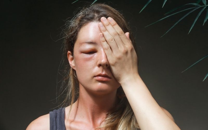 Wasp sting on the eye