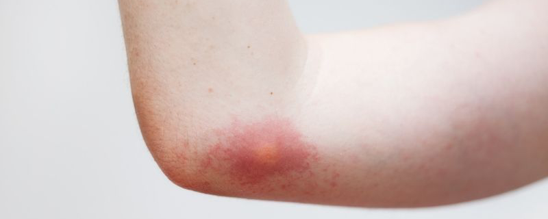 Wasp sting on elbow